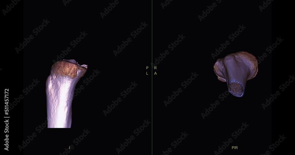 CT Scan of knee joint 3d rendering image turn around on the screen for ...
