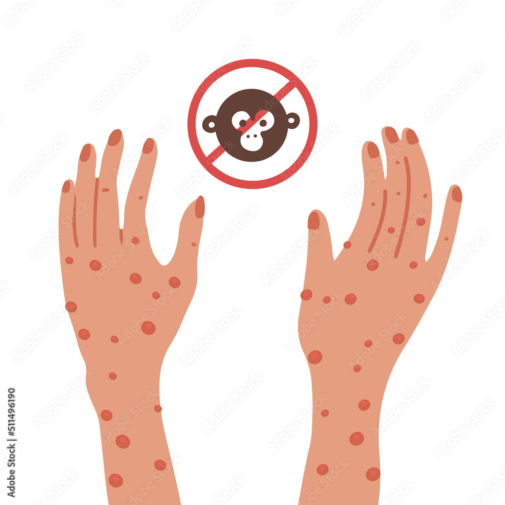 Two Hands with monkeypox virus rashes. Stop new infection. Vector flat illustration isolated. Two Hands with monkeypox virus rashes. Stop new infection. Vector flat illustration isolated.