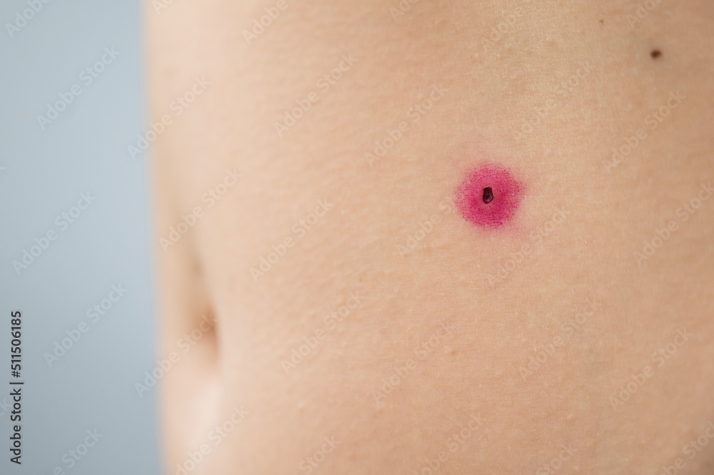 Close-up of a removed wart on a woman's abdomen. Human papillomavirus after burning. Close-up of a removed wart on a woman's abdomen. Human papillomavirus after burning.