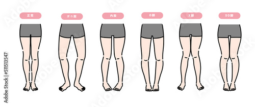矯正が必要な女性の脚のセット