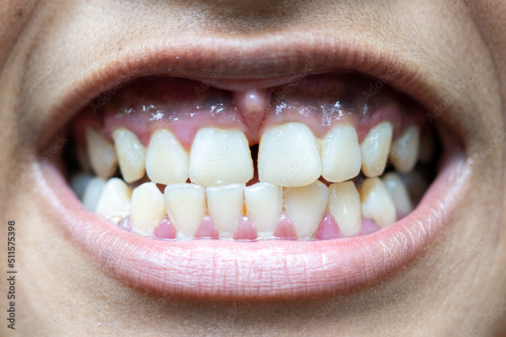 Obraz premium beautiful smile by press ceramic crown and venners 