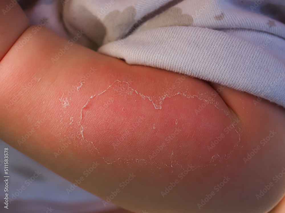 Fototapeta premium sunburn peeling of the skin on the arm of a baby