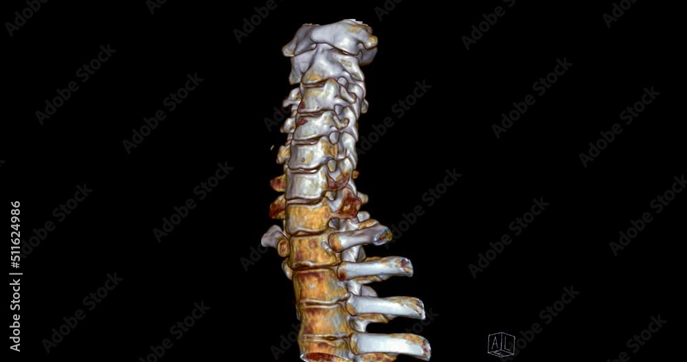 CT SCAN of Cervical Spine ( C-spine ) patient trauma case 3D rendering image . Medical technology concept. CT SCAN of Cervical Spine ( C-spine ) patient trauma case 3D rendering image . Medical technology concept.