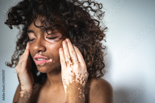 Portrait of young woman with vitiligo condition caress his skin. Close up of attractive young woman with skin disorder. photo