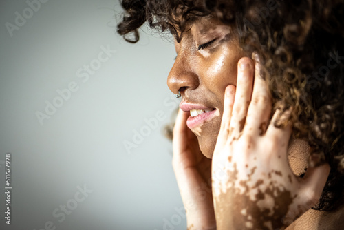 Portrait of young Brazilian woman with Vitiligo on face and hands, close up of details of mouth, closed eyes and curly hair, white background, copyspace photo