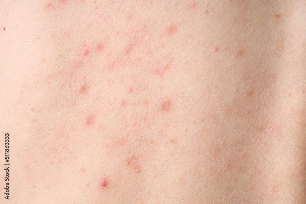 Skin with acne, with red spots. Health problem, skin diseases. Close up Allergy rash. Dermatitis problem of rash. Skin with acne, with red spots. Health problem, skin diseases. Close up Allergy rash. Dermatitis problem of rash.