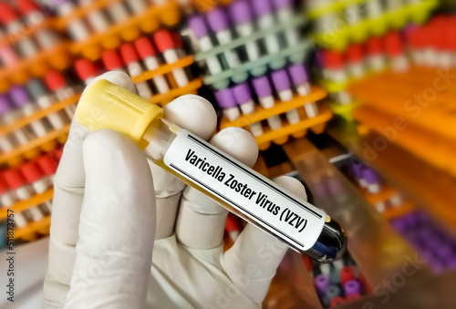 Obraz na plátně Blood sample tube for Varicella zoster virus or chickenpox test