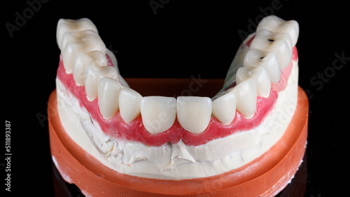 veneers of the upper jaw on a plaster model and a red gum on a black background