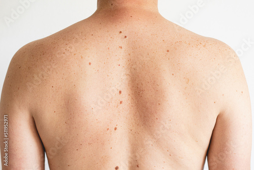 Pigmentation. Close up detail of the bare skin on a man back with scattered moles and freckles. Checking benign moles. Birthmarks on skin