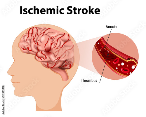 Human with Ischemic stroke
