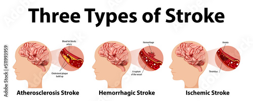 Infographic of common types of stroke photo
