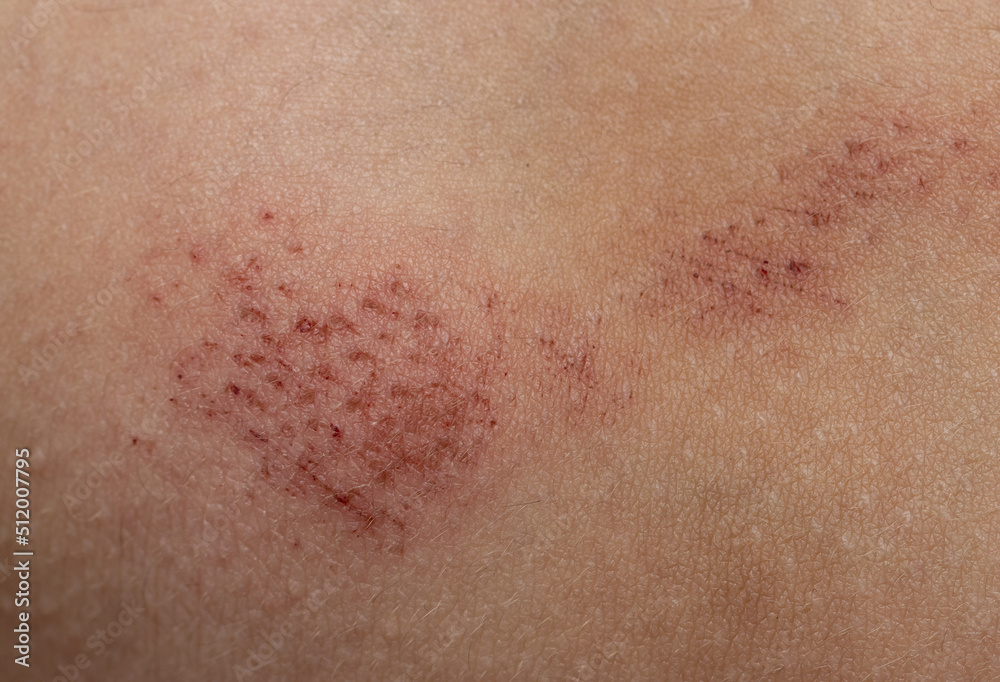 Fototapeta premium scratches on the skin as a background
