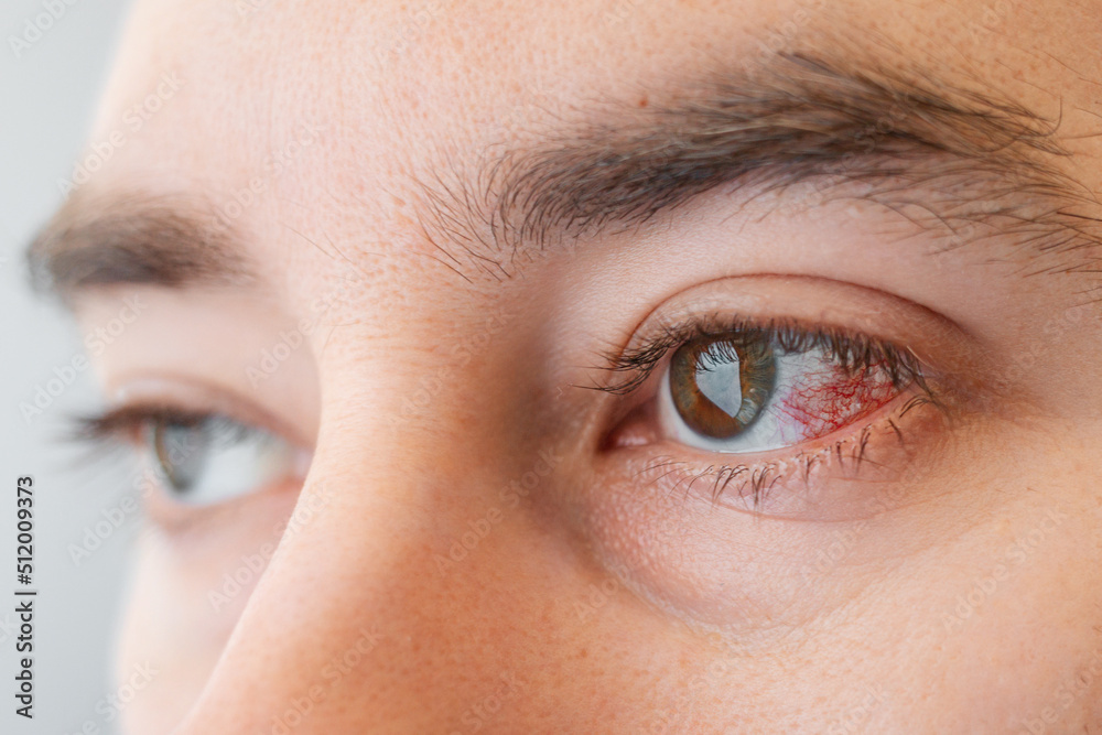 Fototapeta premium Close-up of male brown eyes with redness and burst vessels. The concept of ophthalmology and irritation from lenses