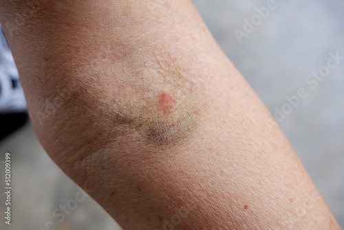 Bruising from using a needle to draw blood in the Foldable join