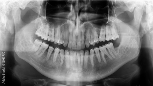 X-ray radiograph picture showing human jaw and teeth