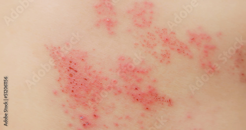 Φωτογραφία man with shingles disease