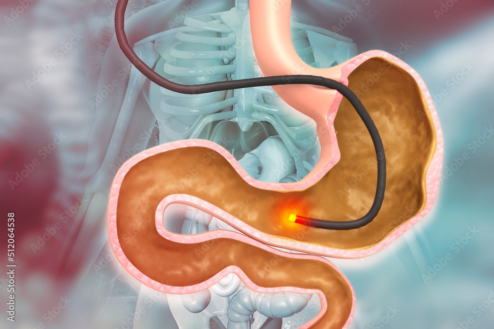 Human Stomach with endoscope and closeup view of bacterium Helicobacter pylori which causes
