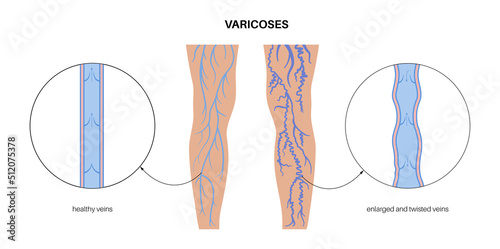 Varicose veins treatment