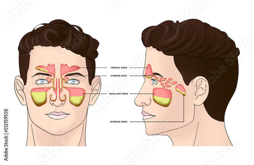 Illustration of man with inflammed paranasal sinuses on white background photo