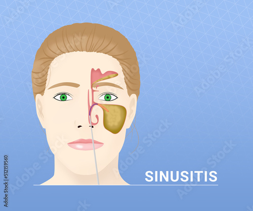 Illustration of woman with inflamed sinus on light blue background