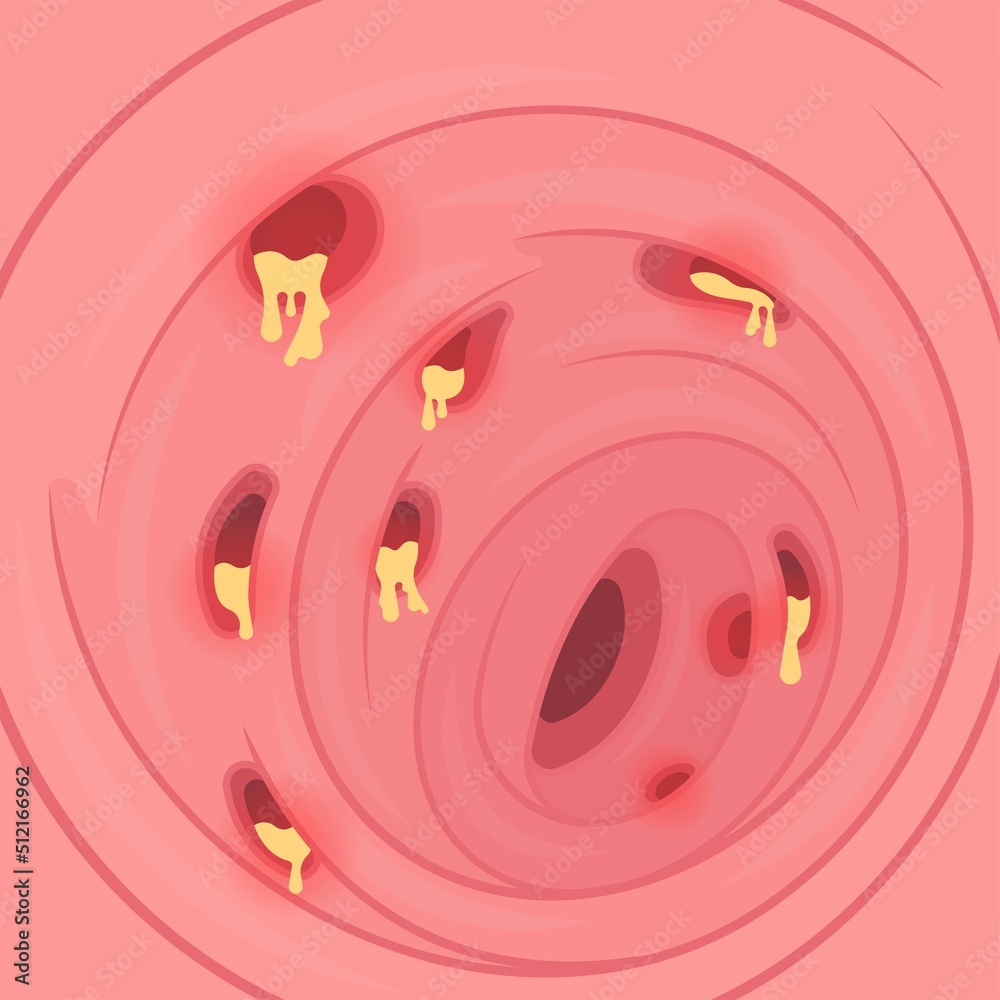 Bowel colon cancer and crohn's disease polyp hernia rectum diverticula
