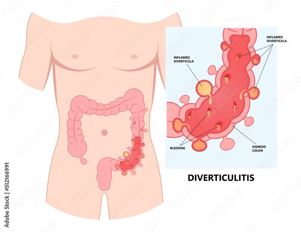 Bowel colon cancer and crohn's disease polyp hernia rectum diverticula ulcer blood stool pain