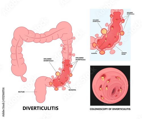 Bowel colon cancer and crohn's disease polyp hernia rectum diverticula ulcer blood stool pain Fecal exam sigmoid diet blocked test C. diff stoma swelling disorder peritonitis rectal