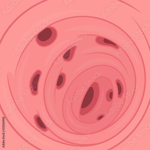 Bowel colon cancer and crohn's disease polyp hernia rectum diverticula ulcer blood stool pain Fecal exam sigmoid diet blocked test C. diff stoma swelling disorder peritonitis rectal