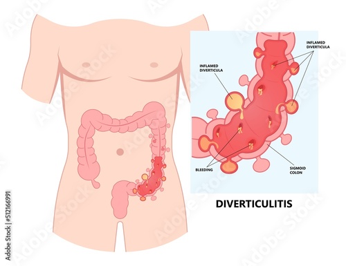 Bowel colon cancer and crohn's disease polyp hernia rectum diverticula ulcer blood stool pain Fecal exam sigmoid diet blocked test C. diff stoma swelling disorder peritonitis rectal