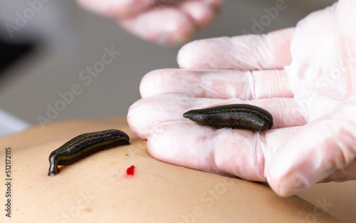 A medical leech full of blood lies on the palm of hand, wearing a glove photo