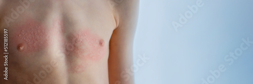 Urticaria on the skin. Red spots of an allergic reaction on the skin of a child. Urticaria symptoms close up