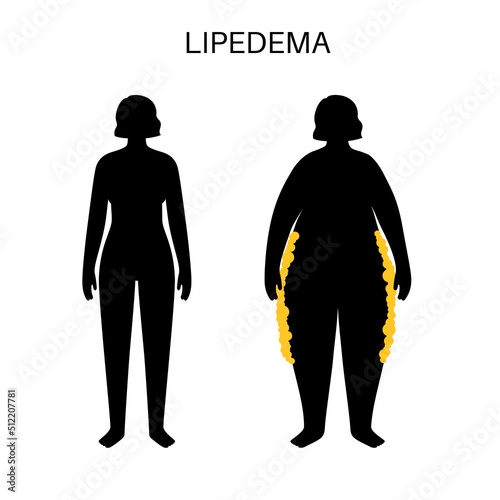 Lipedema fat zones