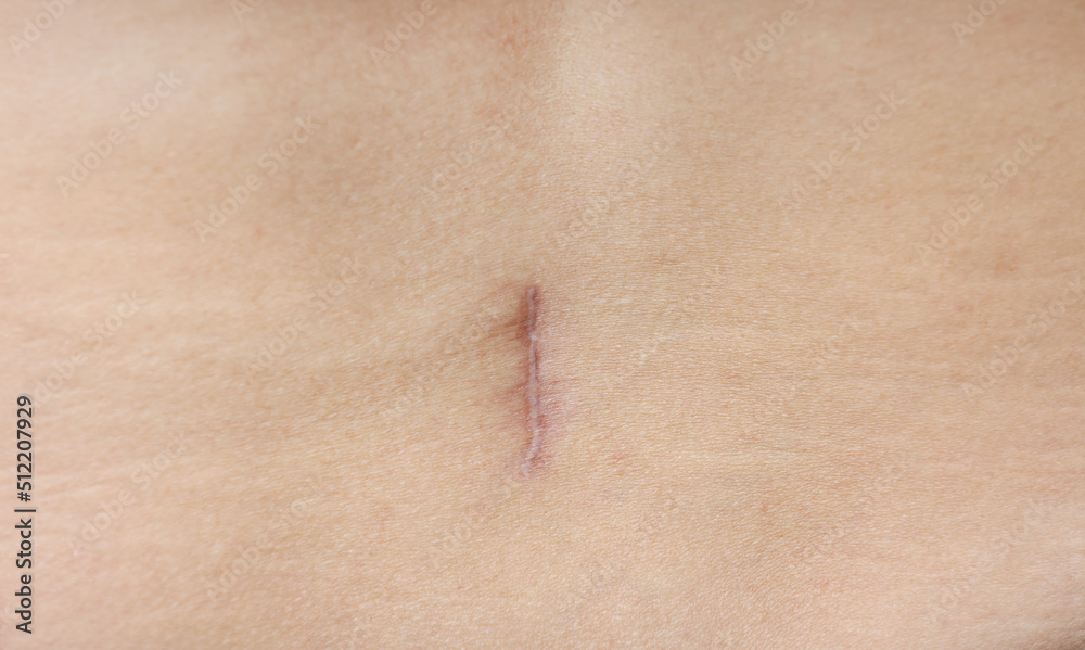 Fototapeta premium close up of careful scar after surgery on the body.