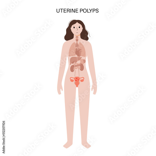 Uterus Polyps Disease