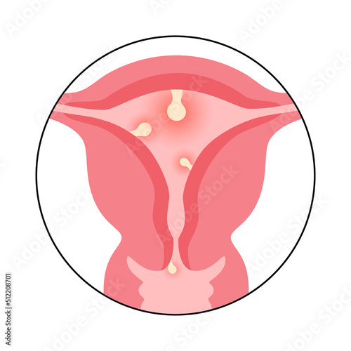 Uterus Polyps Disease