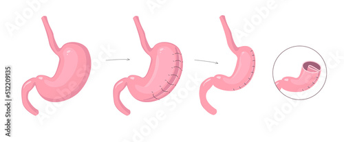 Gastric plication infographics. The explanation picture of stomach reduce method via laparoscopic operation photo