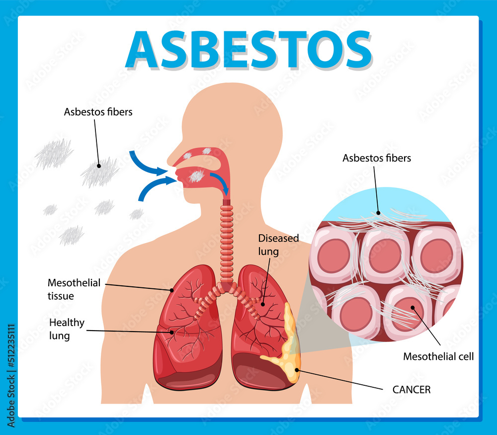 Obraz premium Diagram showing asbestosis in lungs