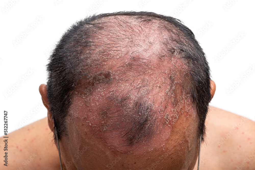 Fototapeta premium Top Shot, Psoriasis is that head-on white background.