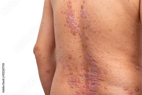 Psoriasis is that back on white background.