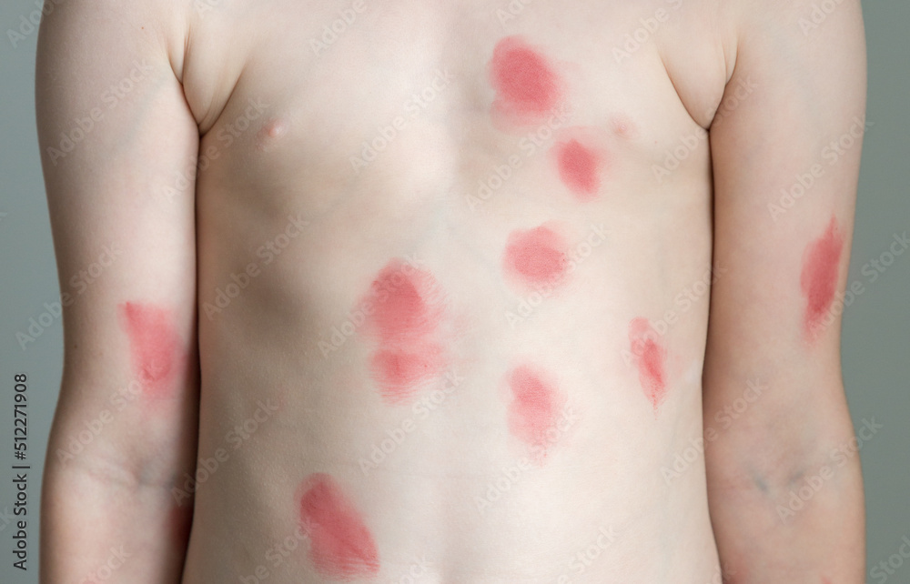 Red rash on the body of child. Monkeypox new disease dangerous over the world. Patient with Monkey Pox, skin diseases. Human body Health problem. Concept of epidemic of monkey pox virus. Red rash on the body of child. Monkeypox new disease dangerous over the world. Patient with Monkey Pox, skin diseases. Human body Health problem. Concept of epidemic of monkey pox virus.