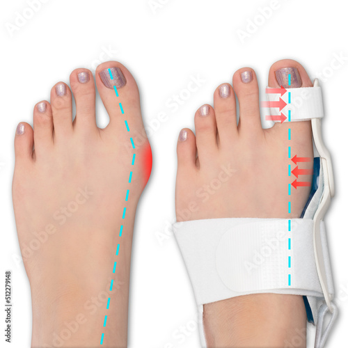 orthosis for bunions on the woman's foot. photo