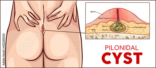  illustration Pilonidal cyst formation photo