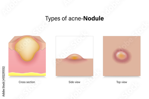 Types of acne. Skin problems. Nodule in cross section, side view and top view. Vector for advertising about beauty and medical treatment.