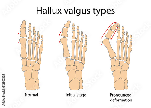 Hallux valgus medical infographic. Vector illustration.