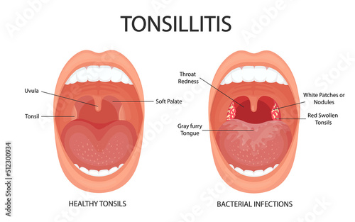Angina, pharyngitis and tonsillitis. Tonsillitis is bacterial. Tonsil infection. Open mouth, anatomy.