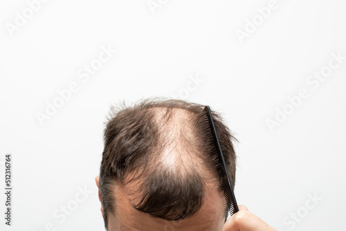 Male pattern baldness how to deal with it