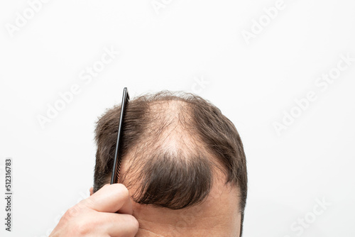 Male pattern baldness how to deal with it