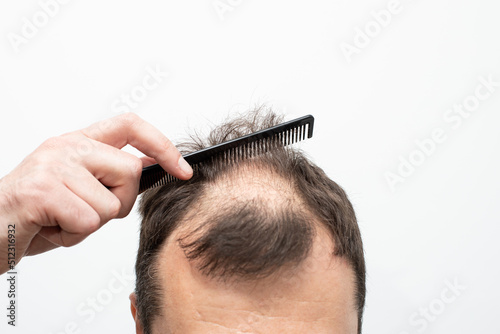 Male pattern baldness how to deal with it