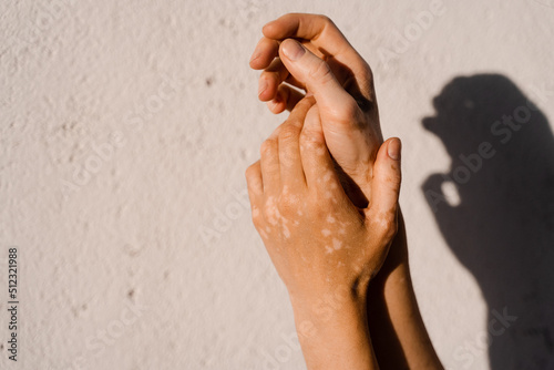 Vitiligo skin pigmentation on the hands of woman. Skin seasonal diseases.