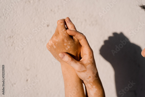 Vitiligo skin pigmentation on the hands of woman. Skin seasonal diseases. photo